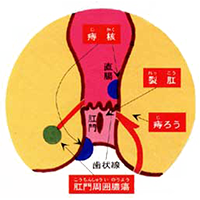 痔について